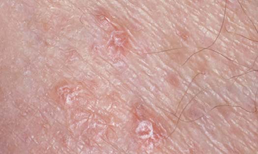 lichen planus vaginal oral cancer Squirting asian lesbian